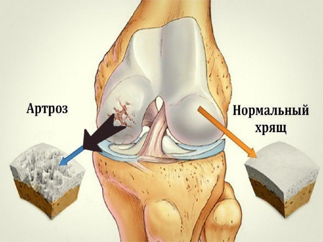 Артрит коленного сустава картинки