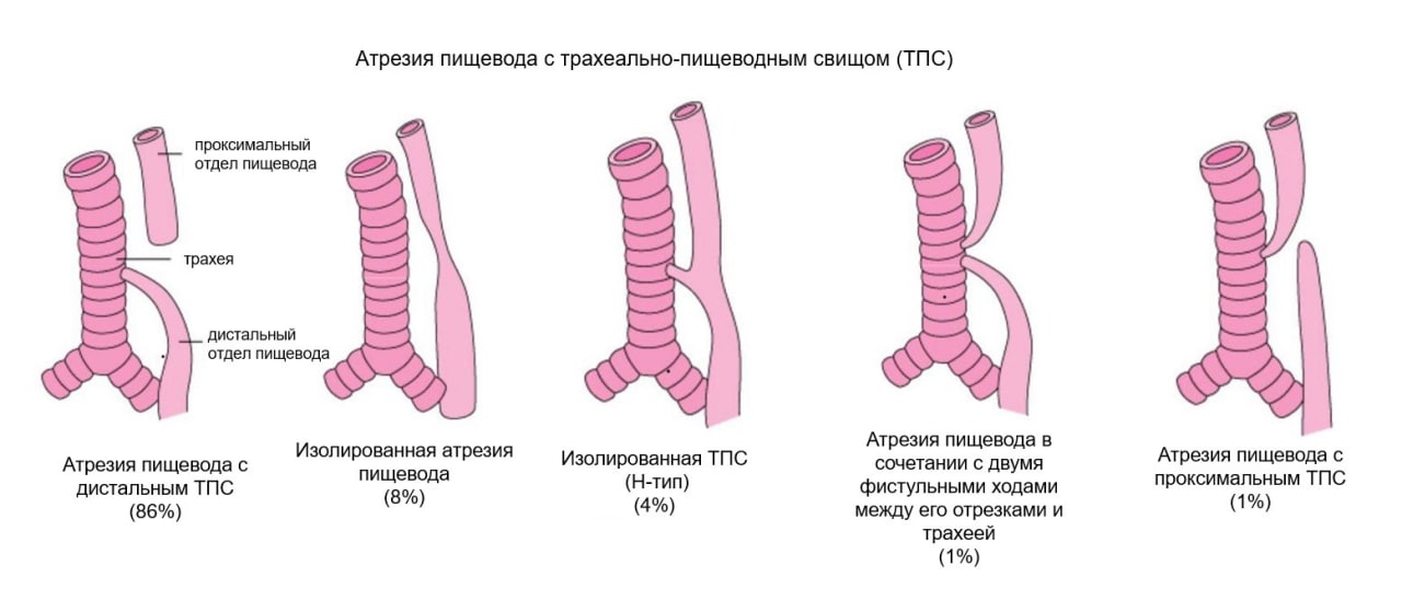 Атрезия пищевода