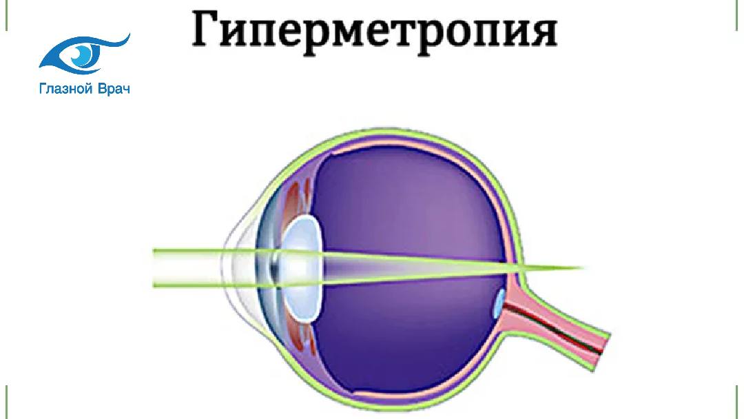 Гиперметропия 3 степени. Гиперметропия глаз степени. Гиперметропия это слабая рефракция. Глазные болезни гиперметропия. Дальнозоркость (гиперметропия).