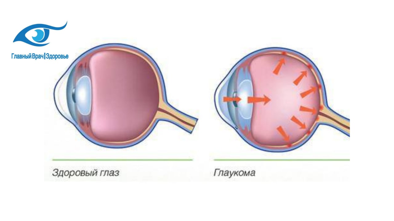 Глаукома что это. Глаукома и здоровый глаз. Глаукома схема.