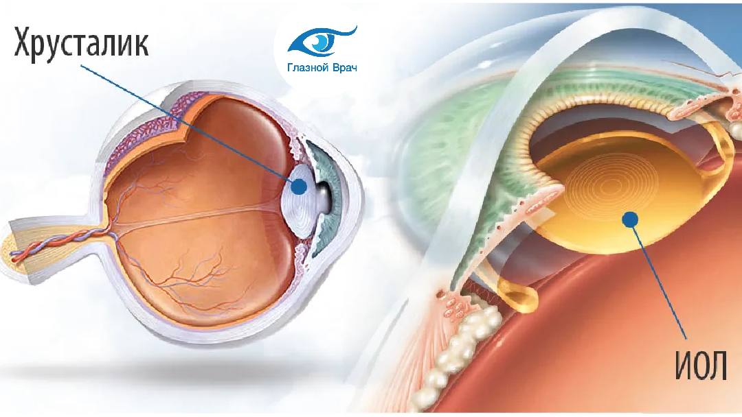 Хрусталик это. Катаракта схема глаза. Искусственный хрусталик. Имплантация торической ИОЛ. Хрусталик для глаза американский.
