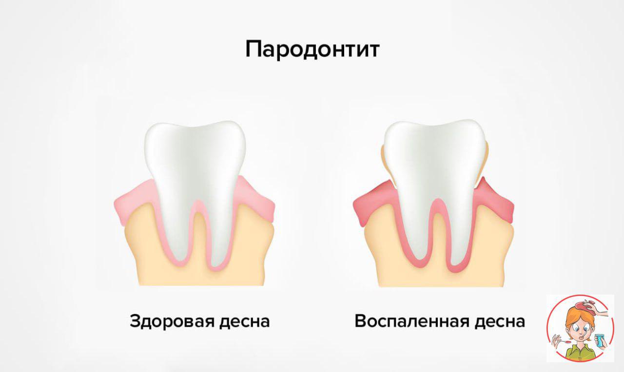 Воспаление десен лечение. Заболевания десен у детей. Воспалительные заболевания десен у детей.