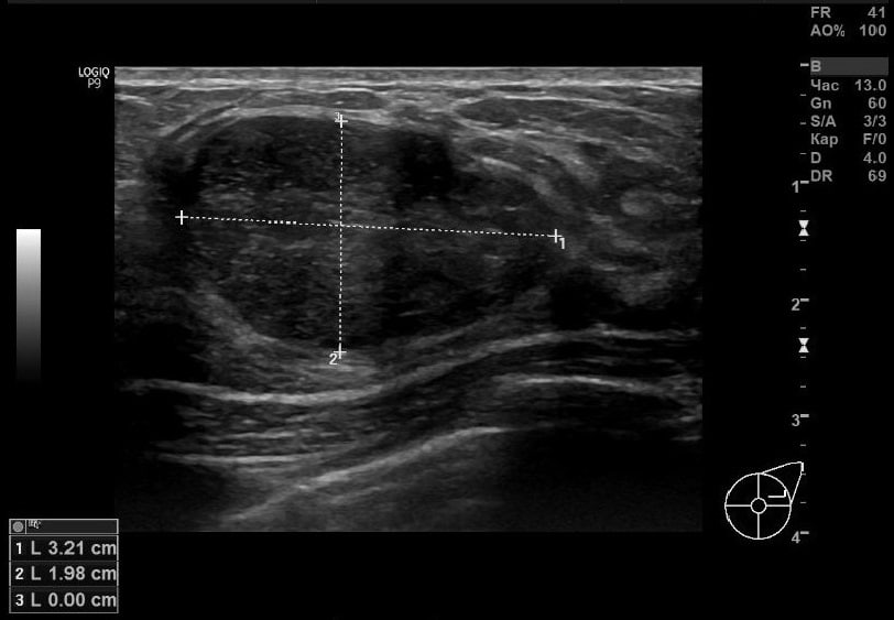 Четкие контуры фиброаденомы