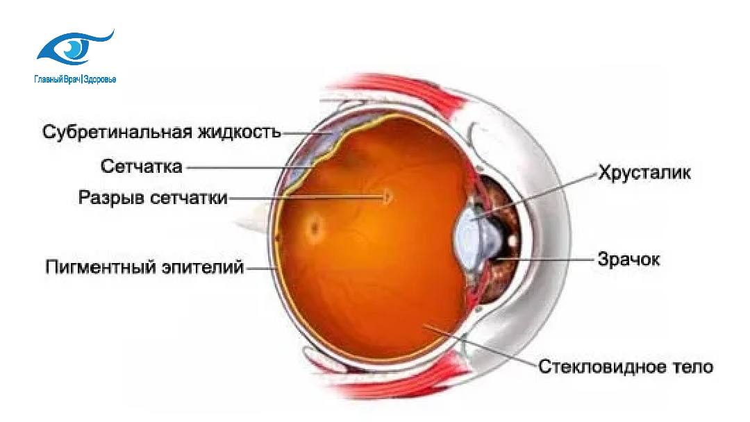 Жидкость в сетчатке. Разрыв сетчатки (retinal tear).