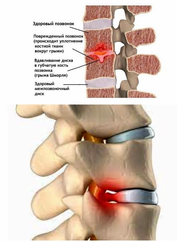Грыжа шморля что это фото